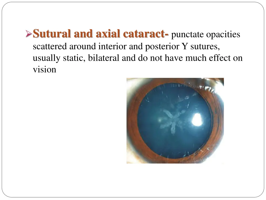 sutural and axial cataract punctate opacities