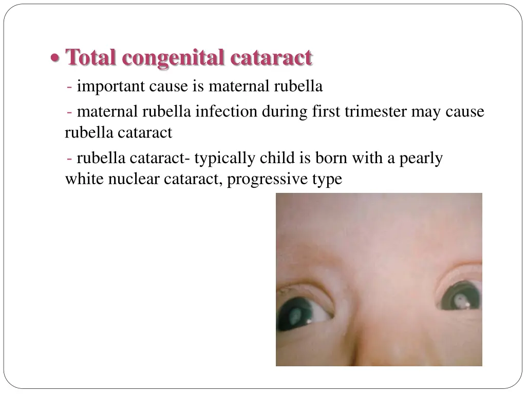 total congenital cataract important cause