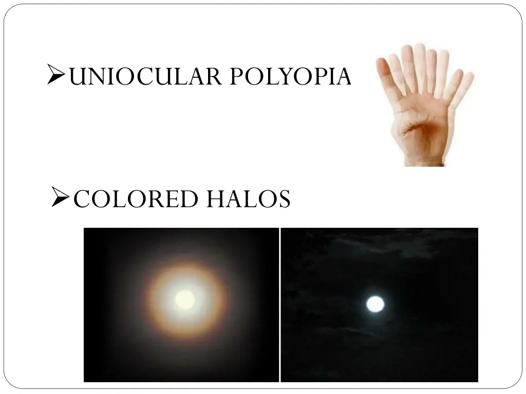 uniocular polyopia