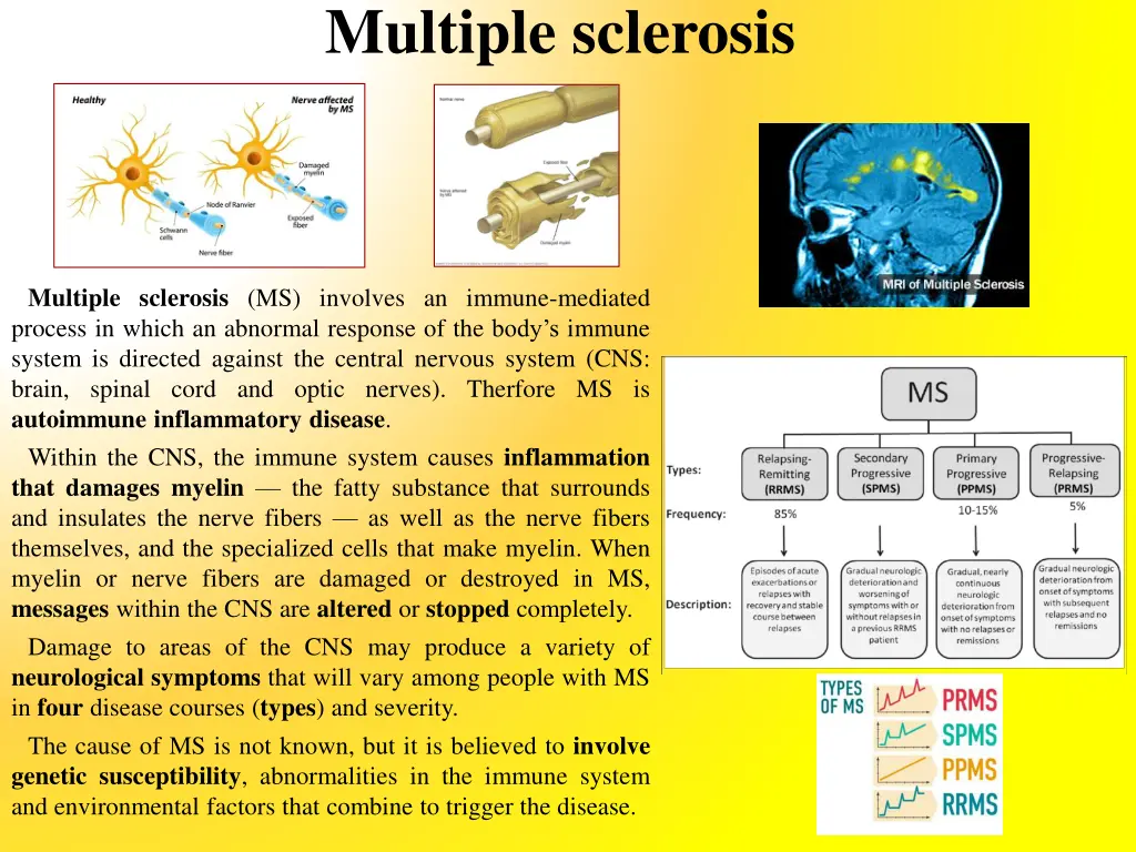 multiple sclerosis