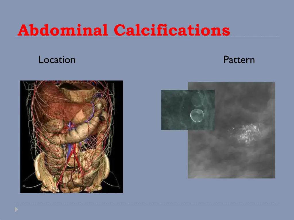 abdominal calcifications