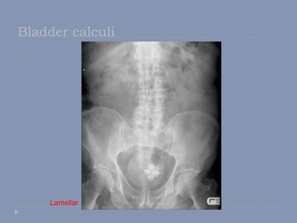 bladder calculi