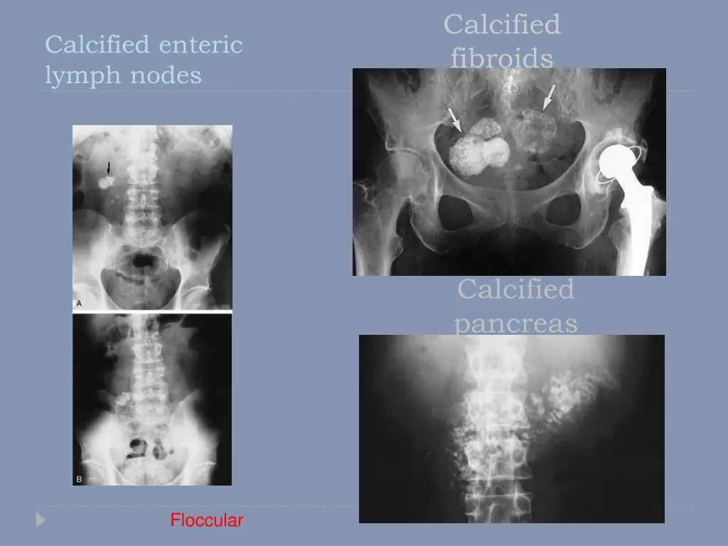 calcified fibroids