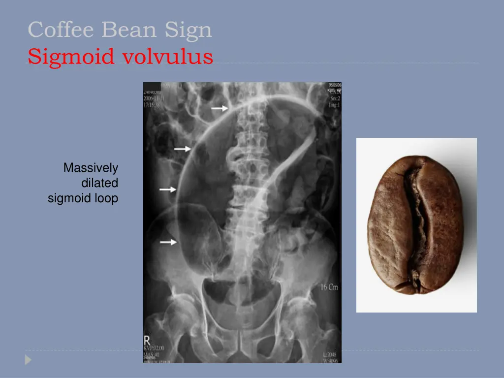 coffee bean sign sigmoid volvulus