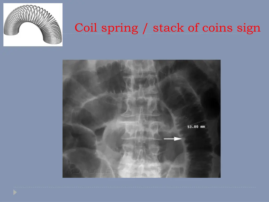 coil spring stack of coins sign