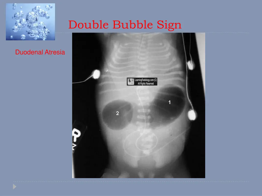 double bubble sign