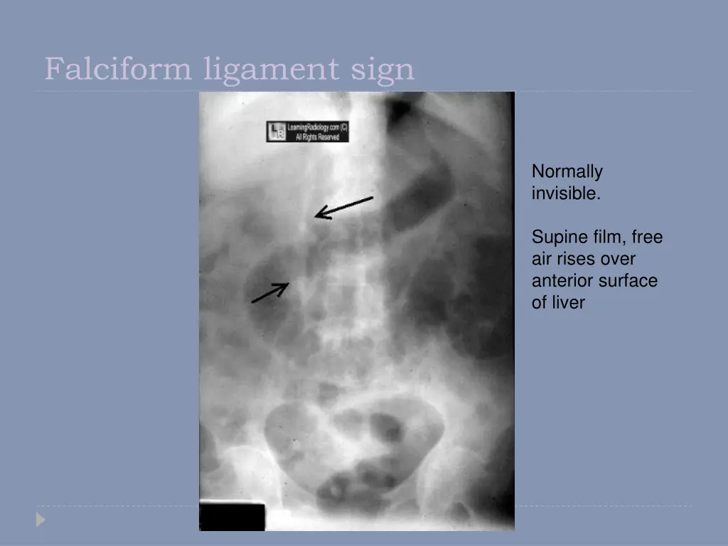 falciform ligament sign