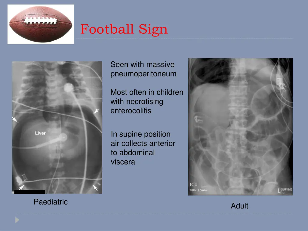 football sign