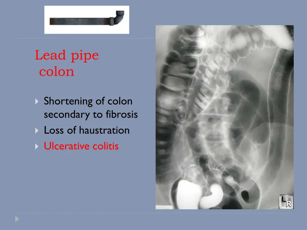 lead pipe colon