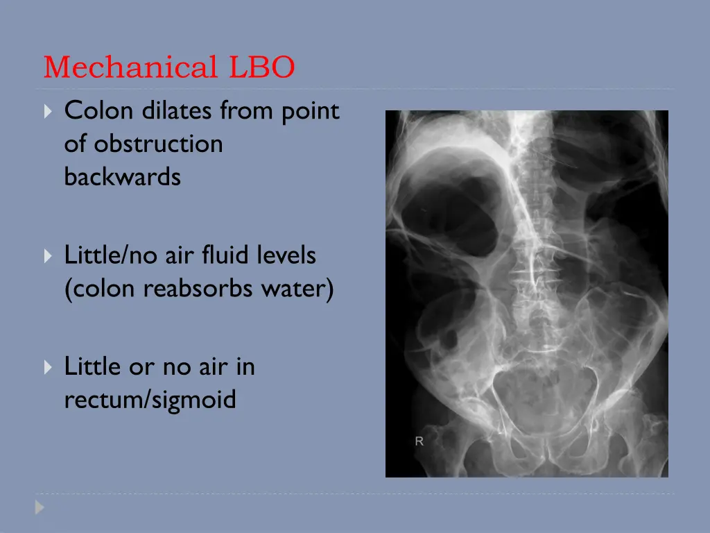 mechanical lbo colon dilates from point