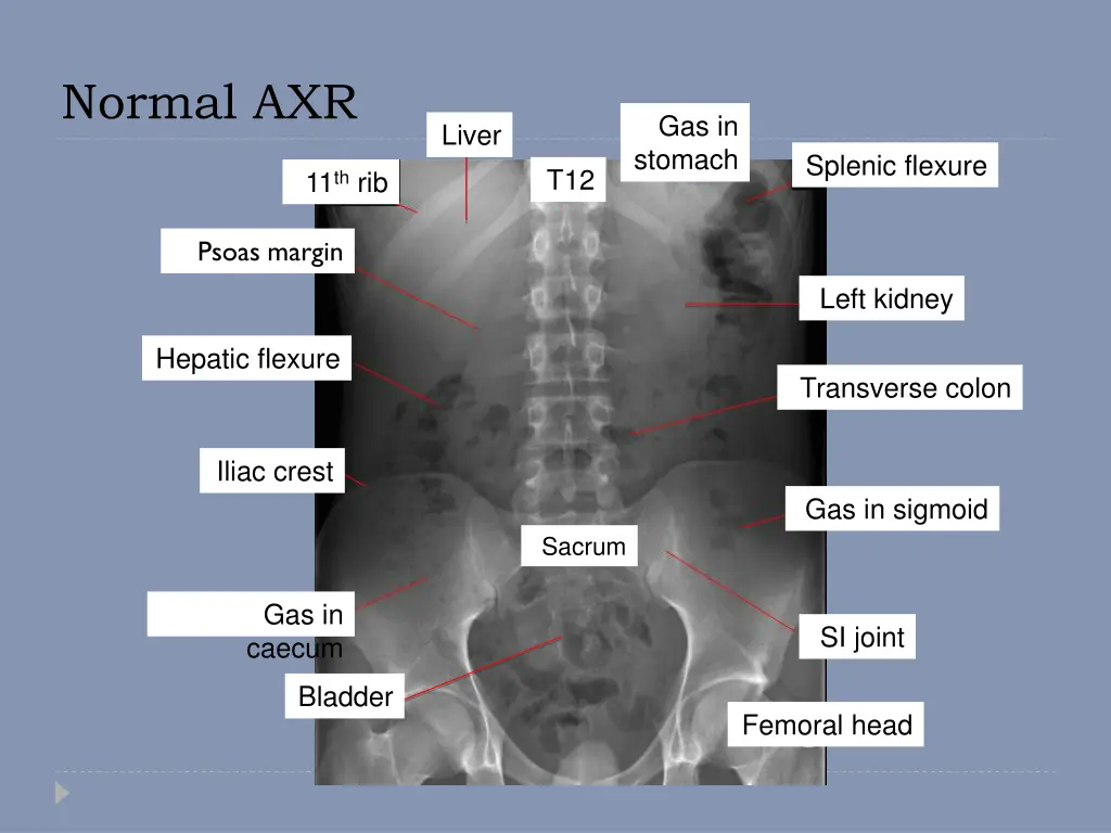 normal axr 1