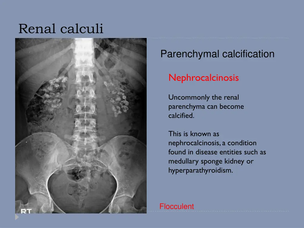 renal calculi 1