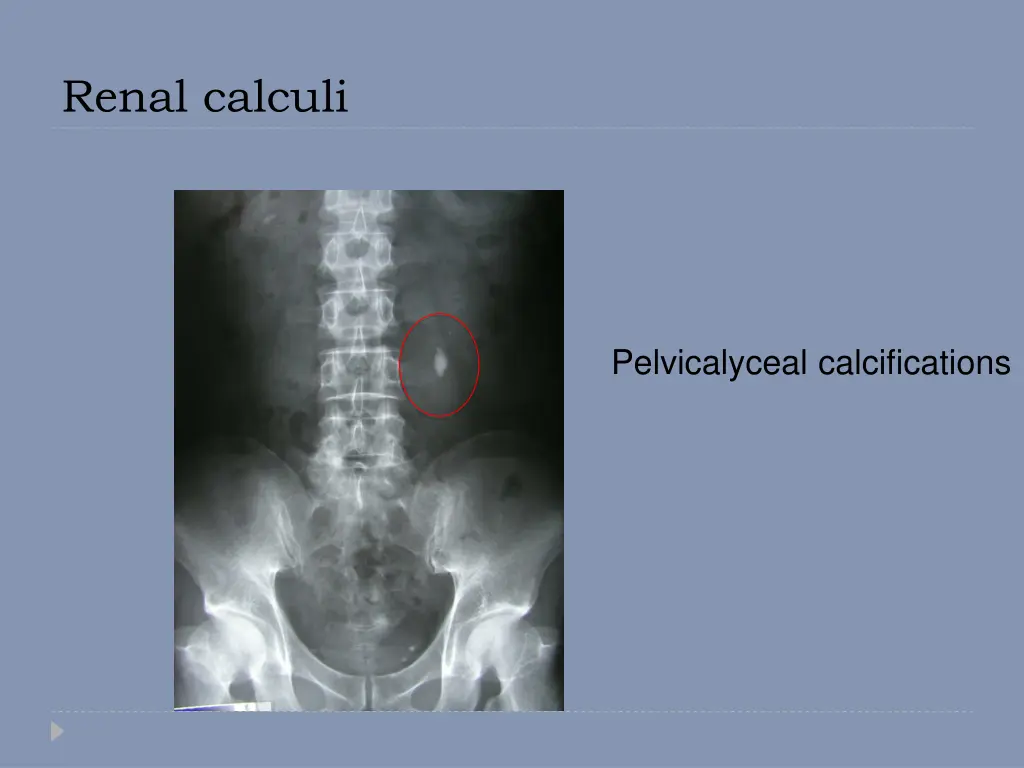 renal calculi