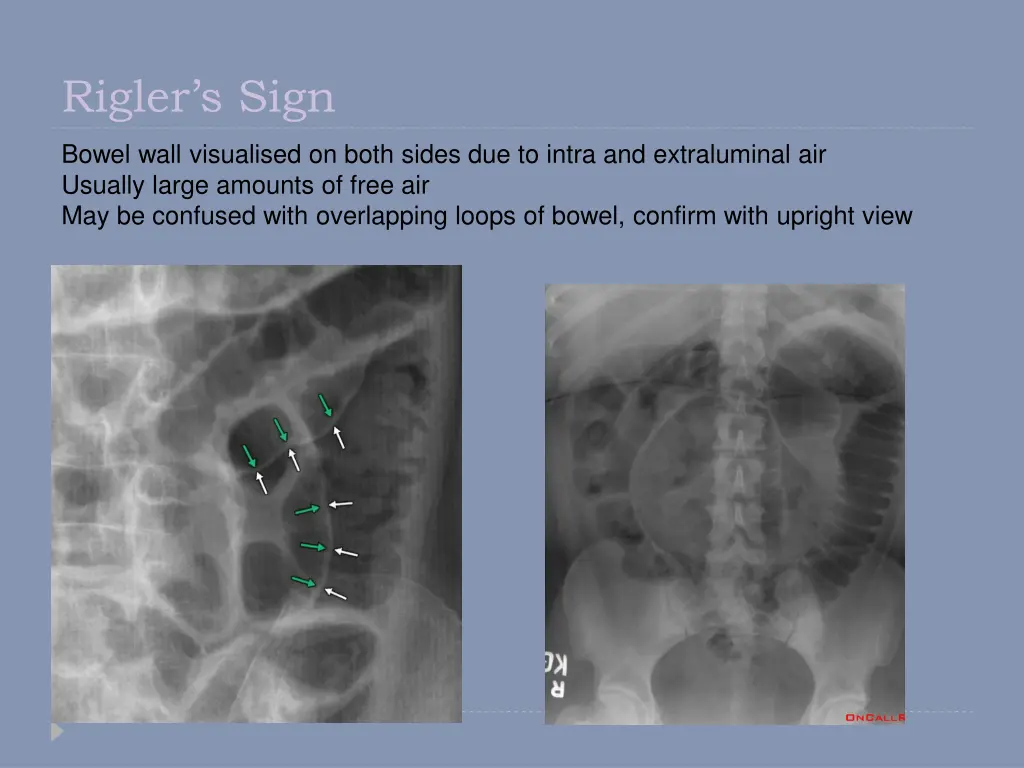 rigler s sign