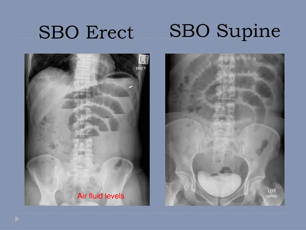 sbo supine