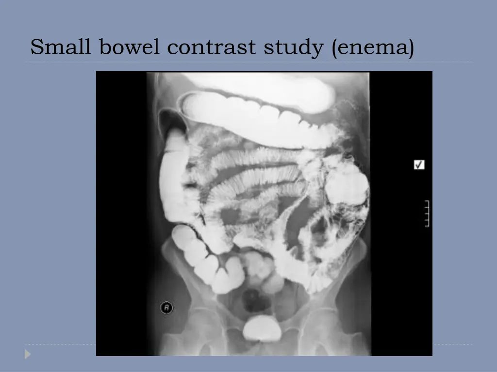 small bowel contrast study enema