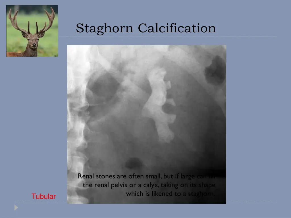 staghorn calcification