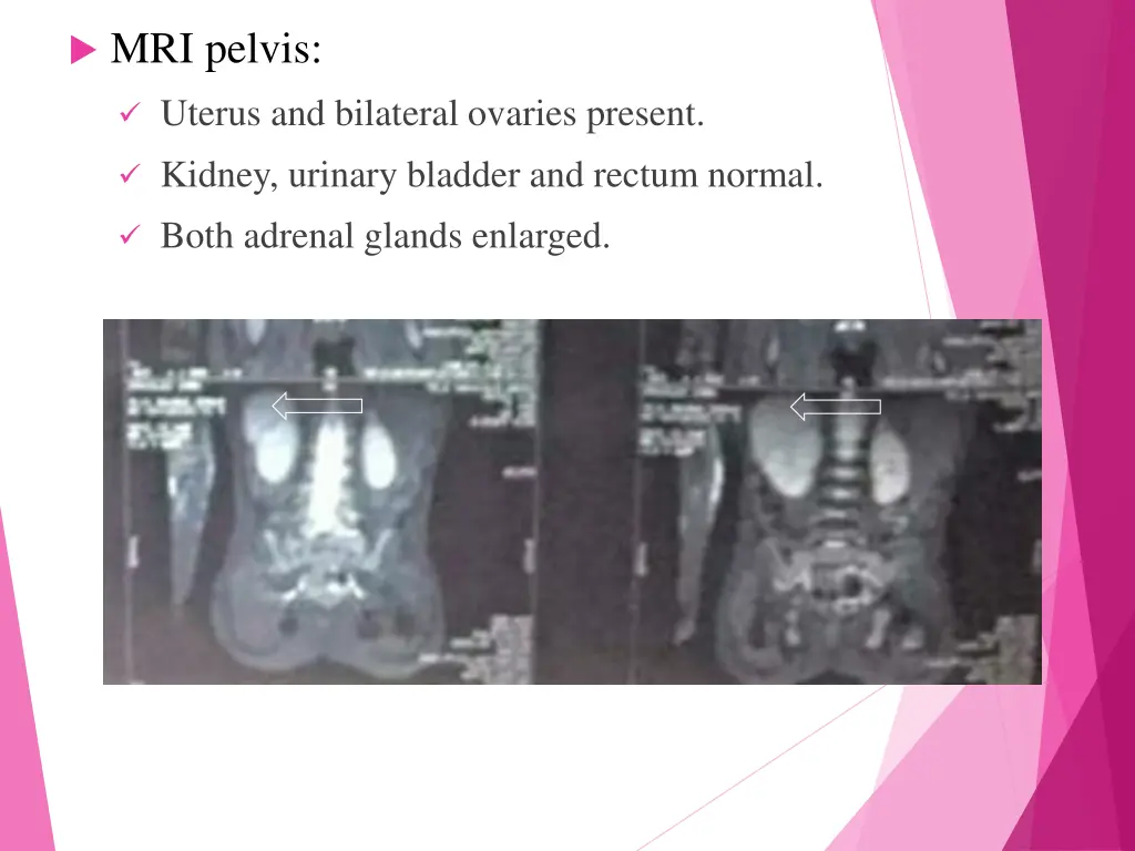 mri pelvis