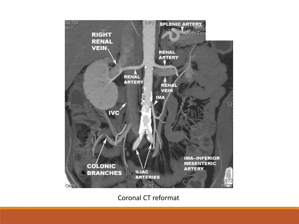 coronal ct reformat