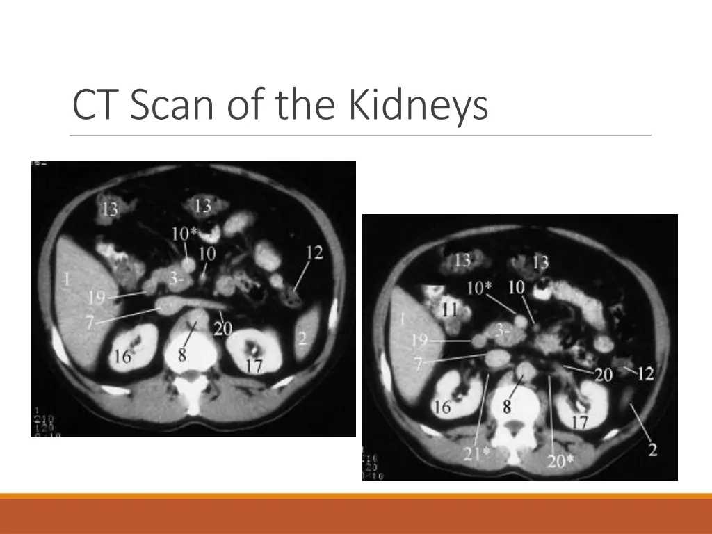 ct scan of the kidneys