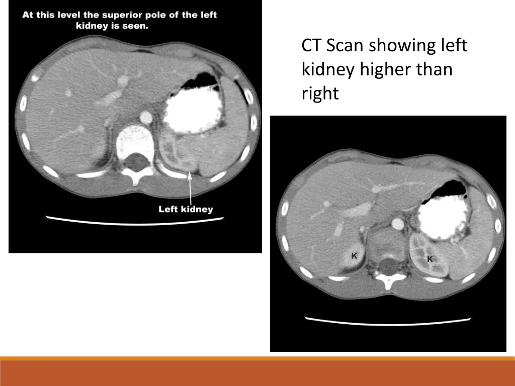 ct scan showing left kidney higher than right