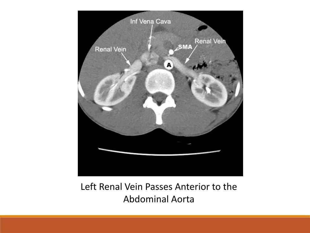 left renal vein passes anterior to the abdominal