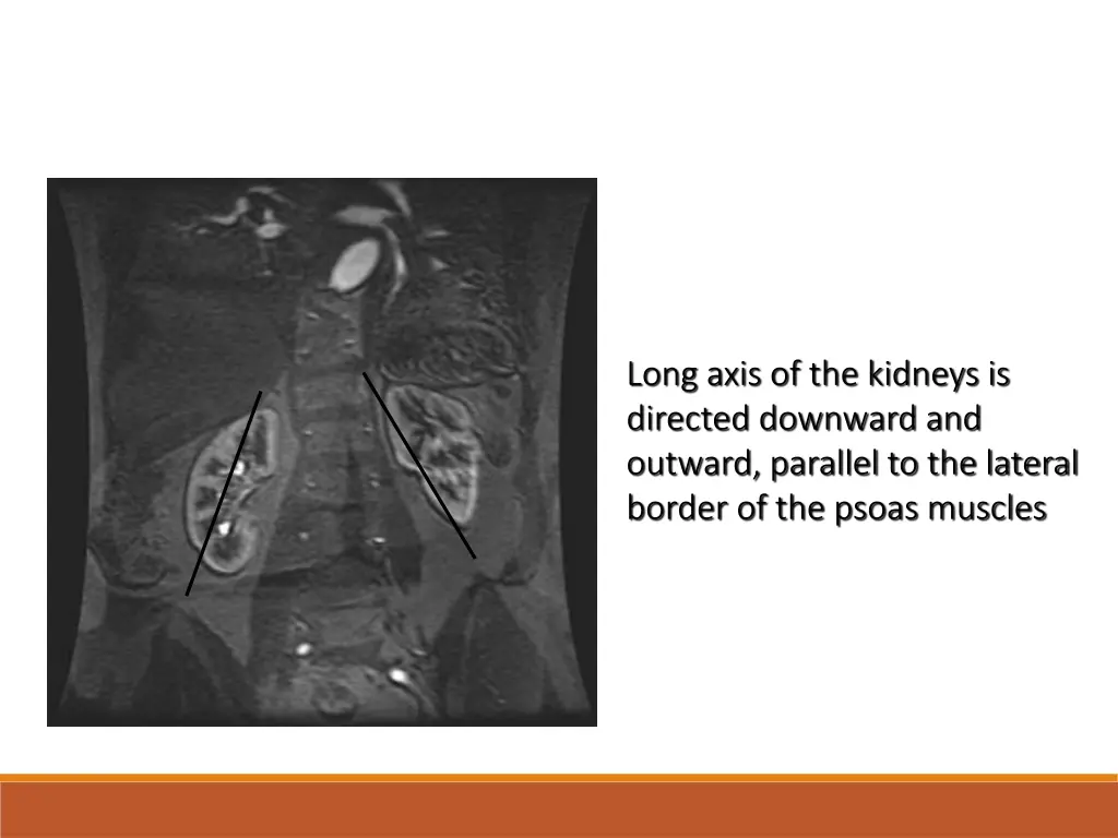 long axis of the kidneys is directed downward