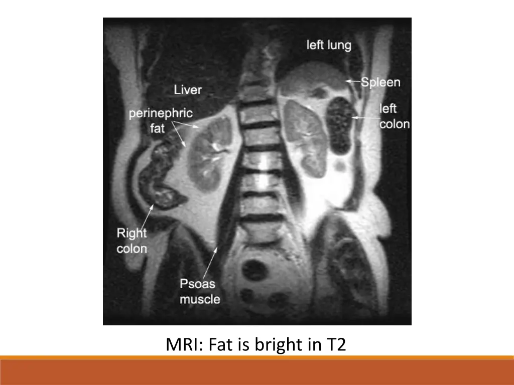 mri fat is bright in t2