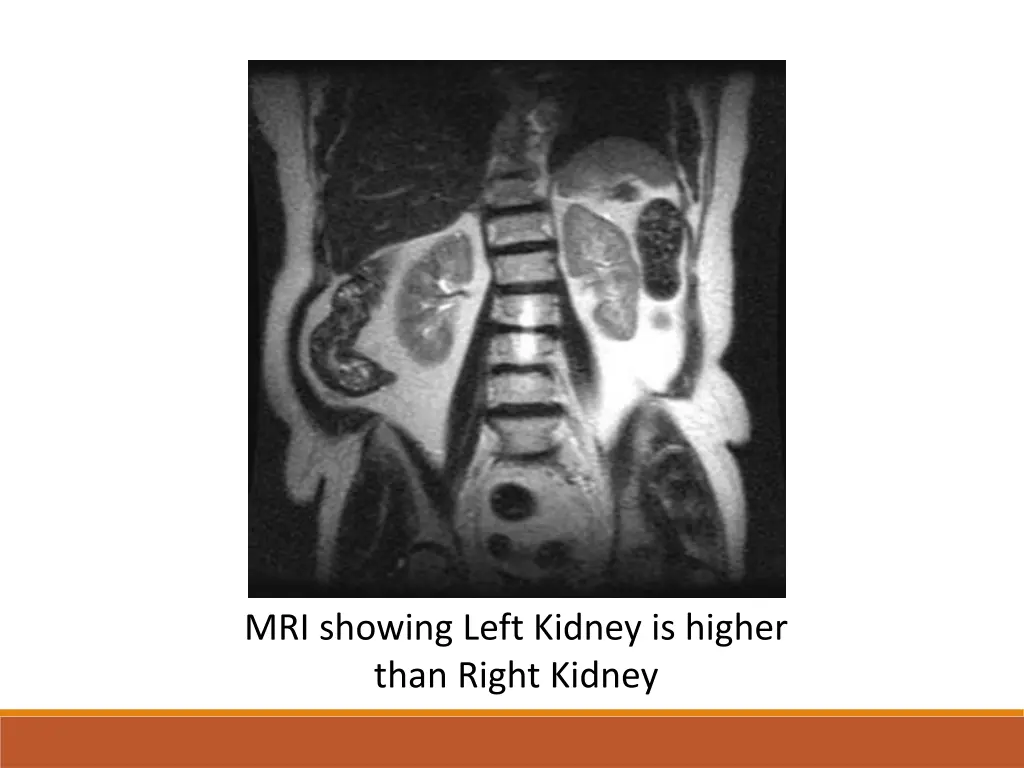 mri showing left kidney is higher than right