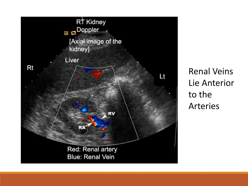 renal veins lie anterior to the arteries