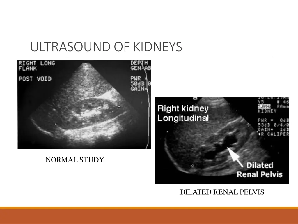 ultrasound of kidneys