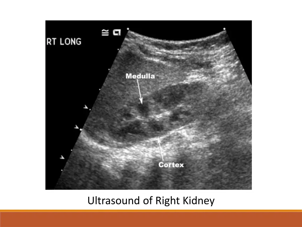 ultrasound of right kidney 1