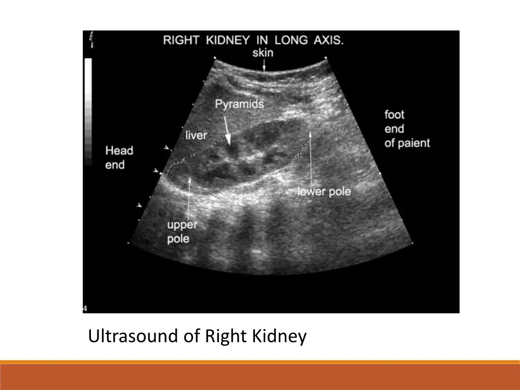 ultrasound of right kidney