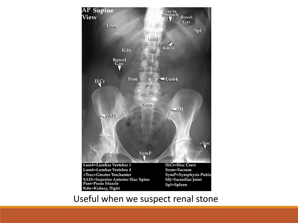 useful when we suspect renal stone