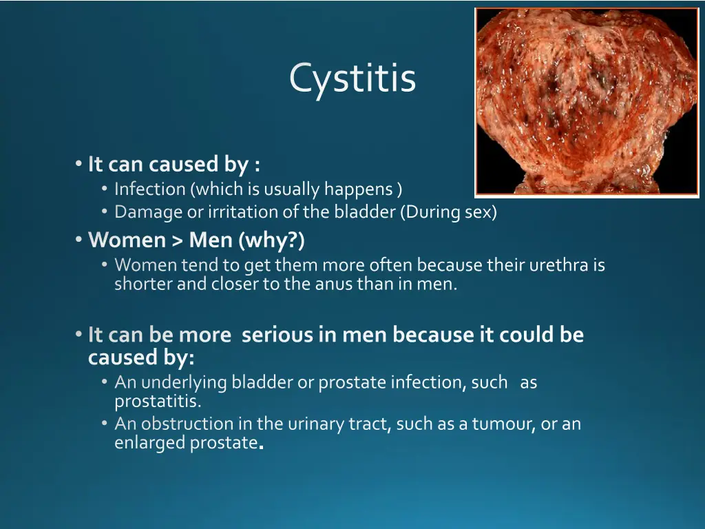 cystitis