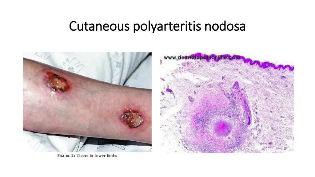 cutaneous polyarteritis nodosa cutaneous 2