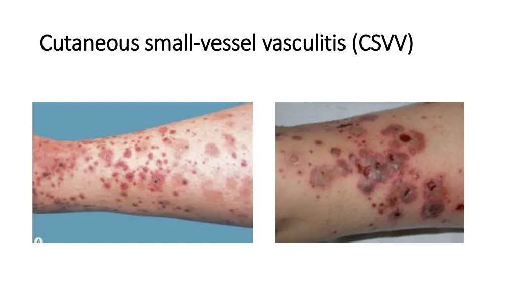 cutaneous small cutaneous small vessel vasculitis 1