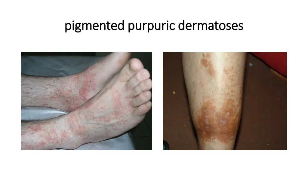 pigmented purpuric dermatoses pigmented purpuric 1