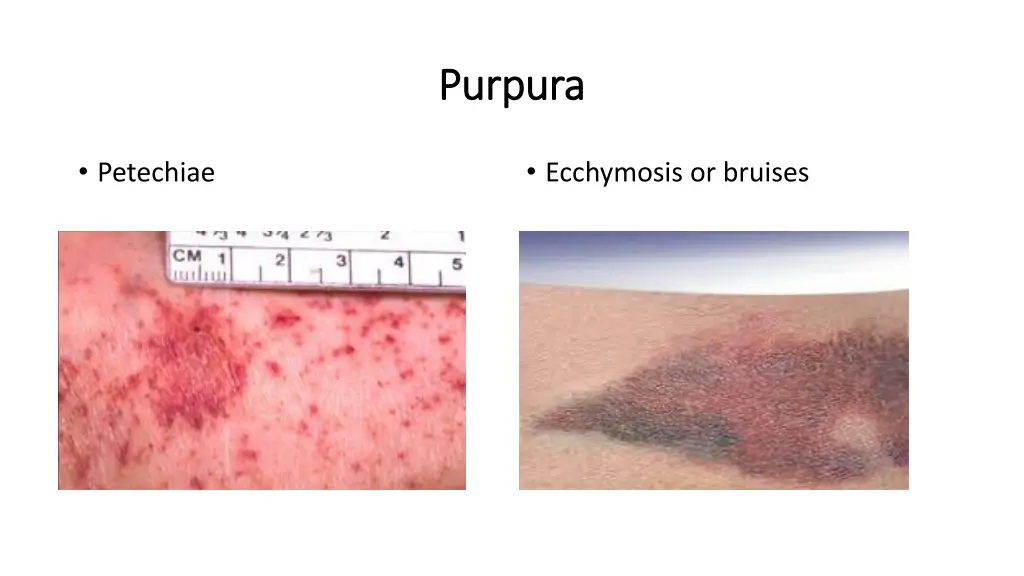 purpura purpura 1