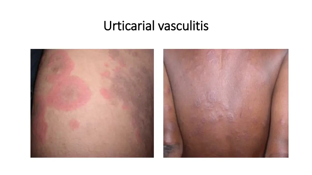 urticarial vasculitis urticarial vasculitis 1