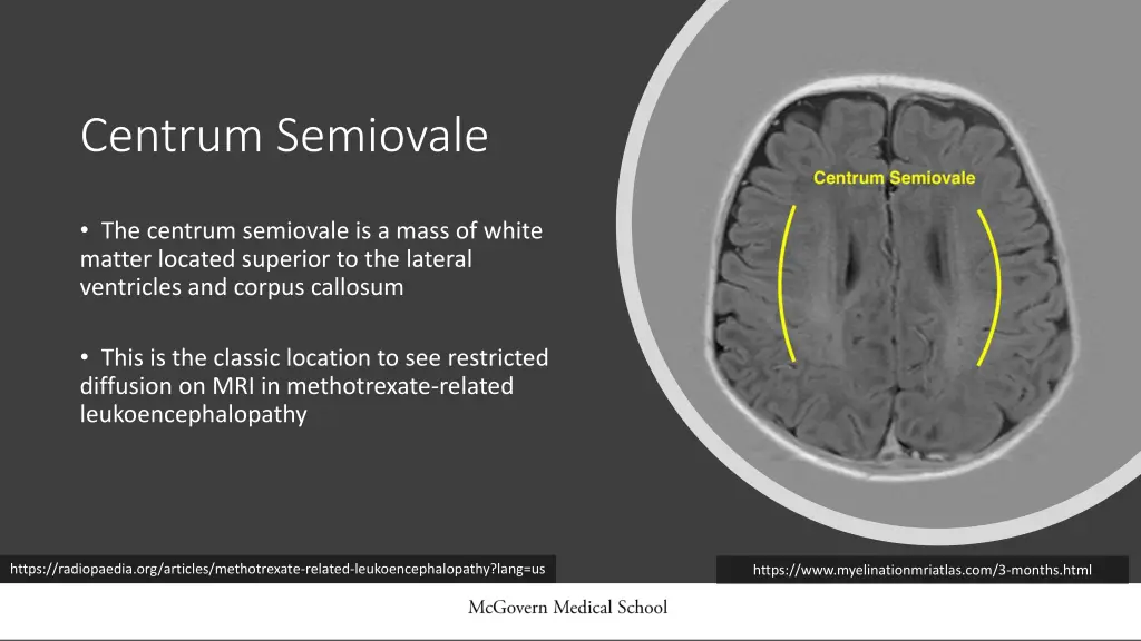 centrum semiovale