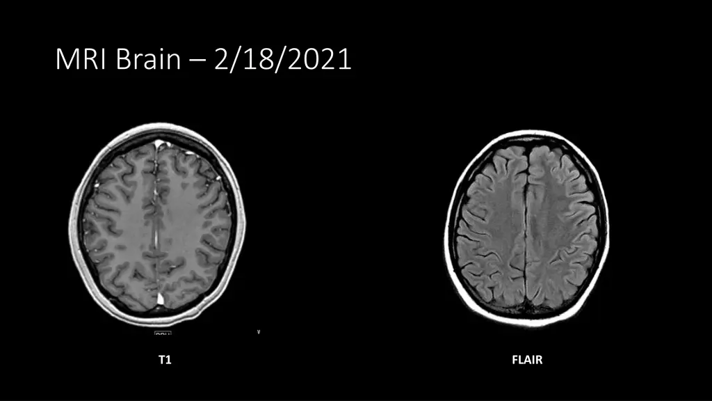 mri brain 2 18 2021 1