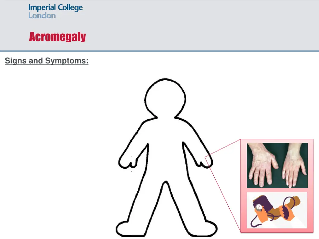 acromegaly 2