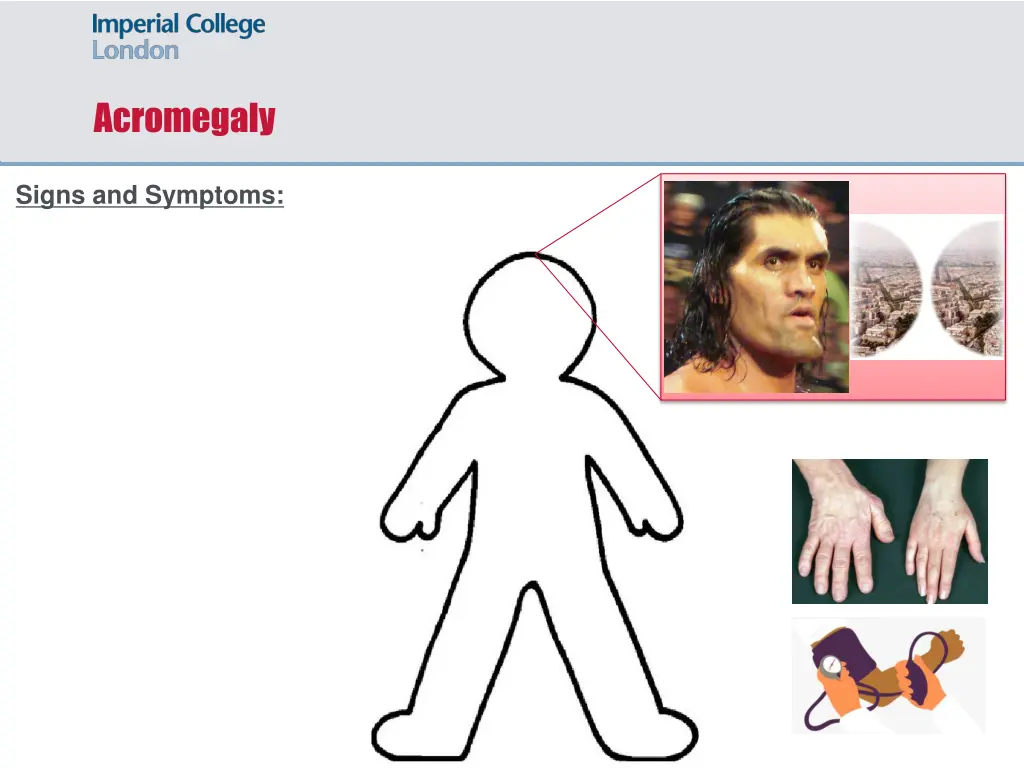 acromegaly 3