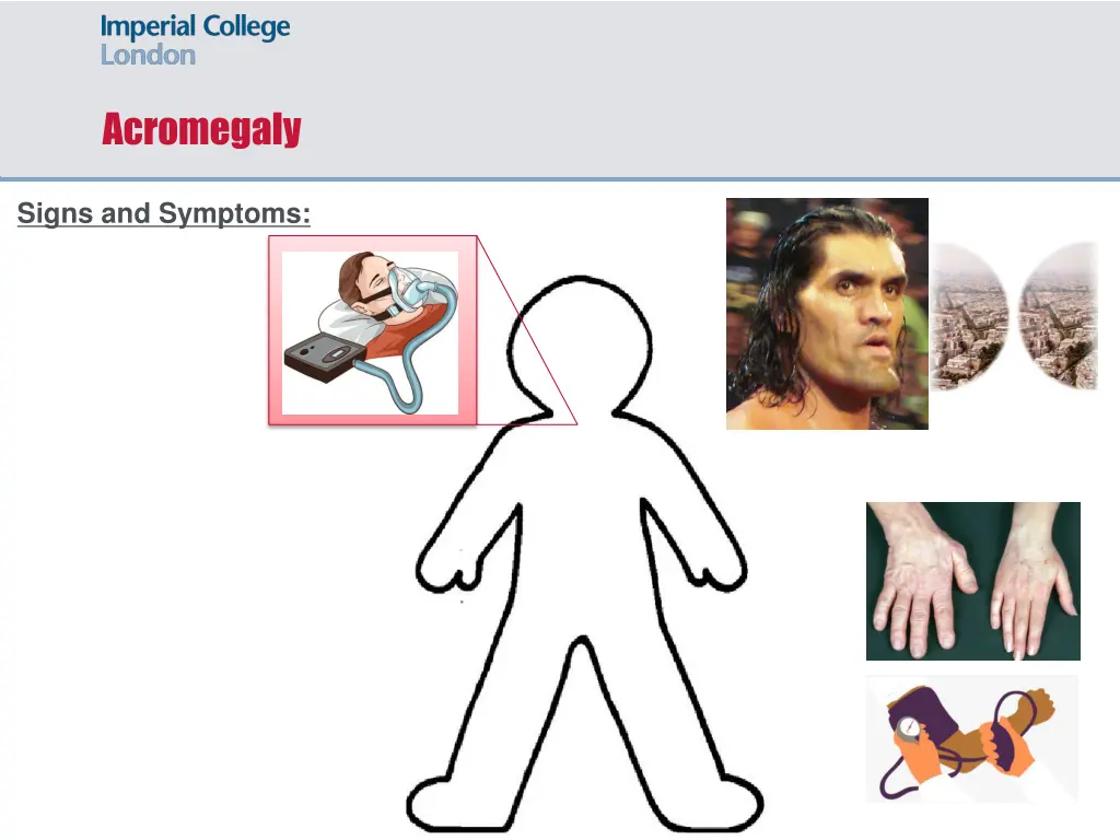 acromegaly 4