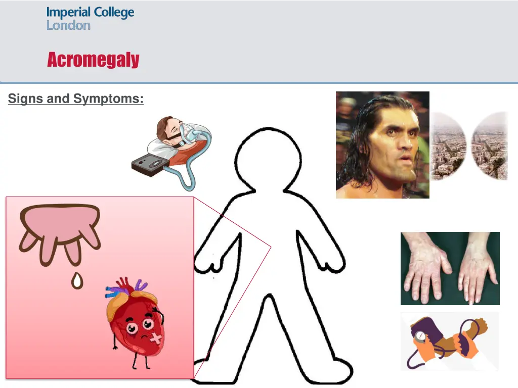 acromegaly 5