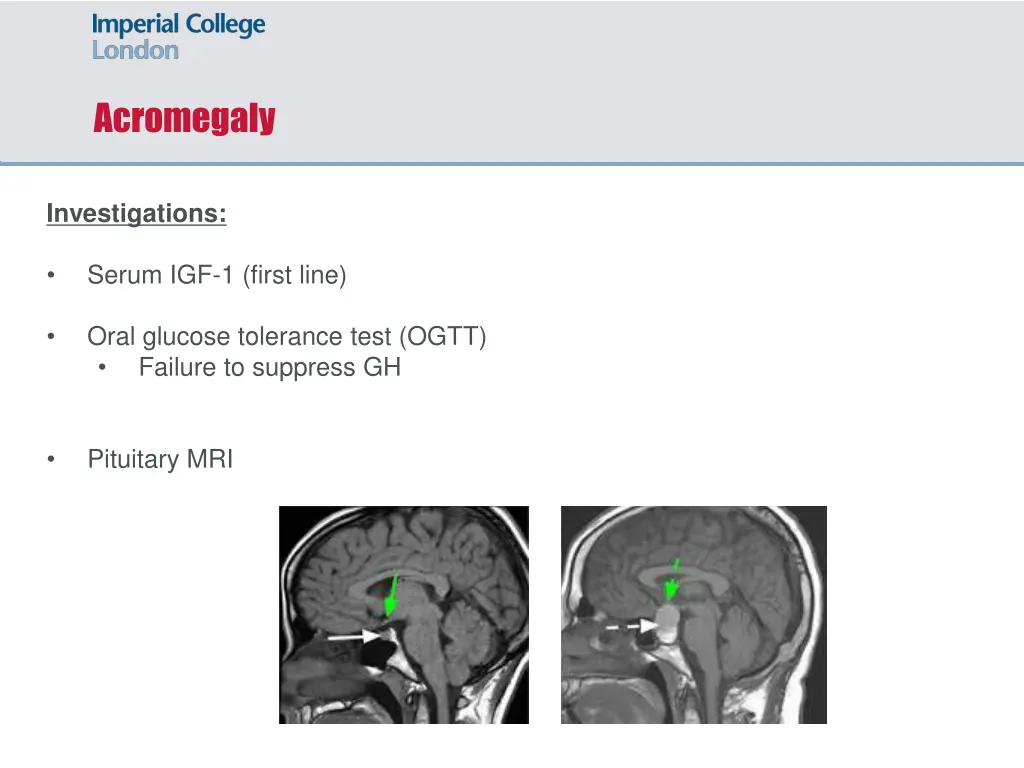 acromegaly 6