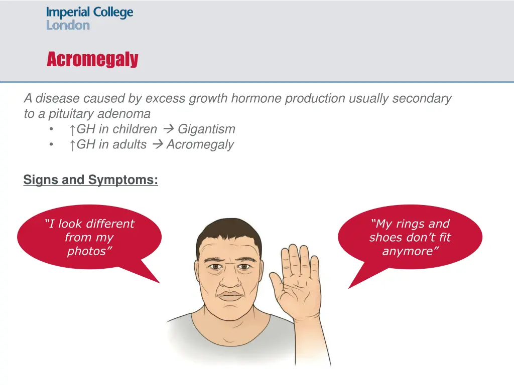 acromegaly