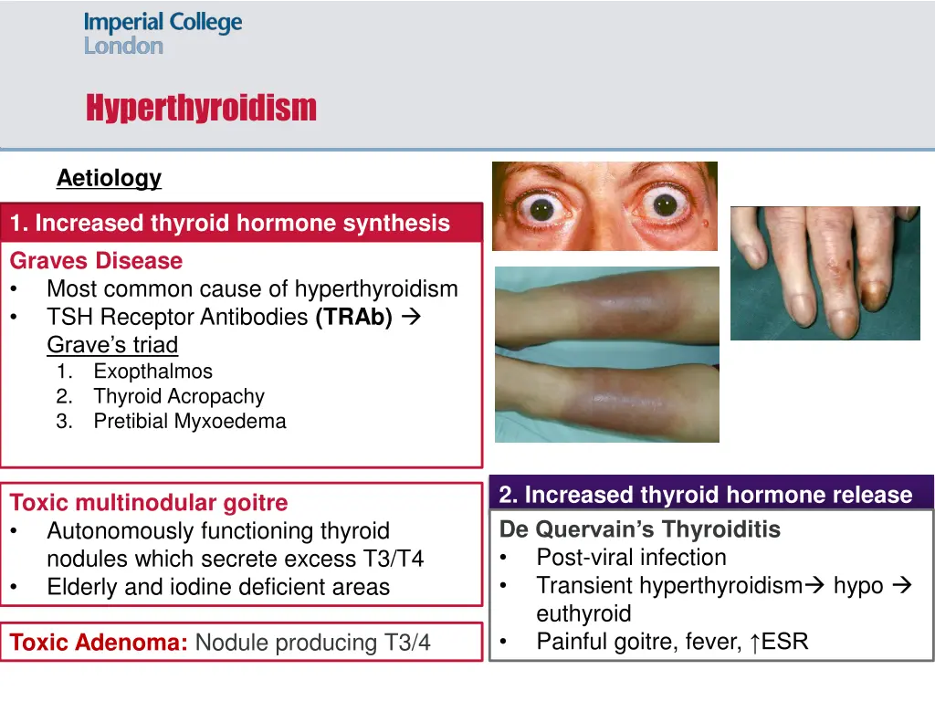 hyperthyroidism 1