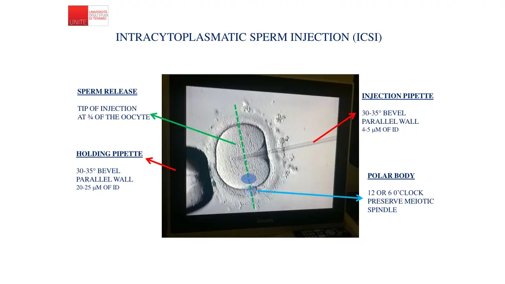 intracytoplasmatic sperm injection icsi